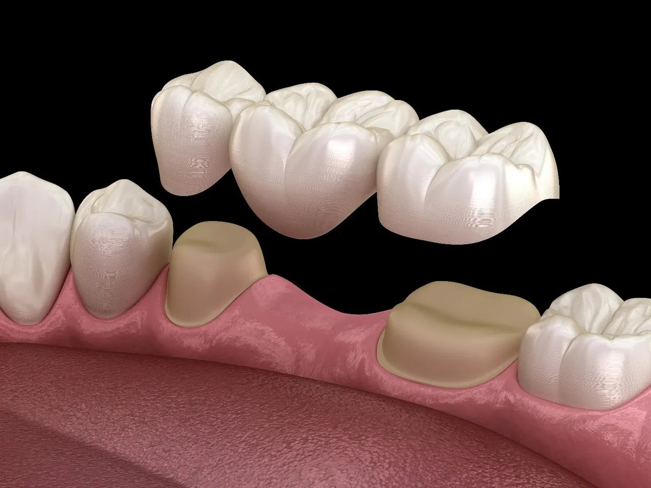 Illustration of a three-unit dental bridge being placed over two prepared teeth to replace a missing tooth