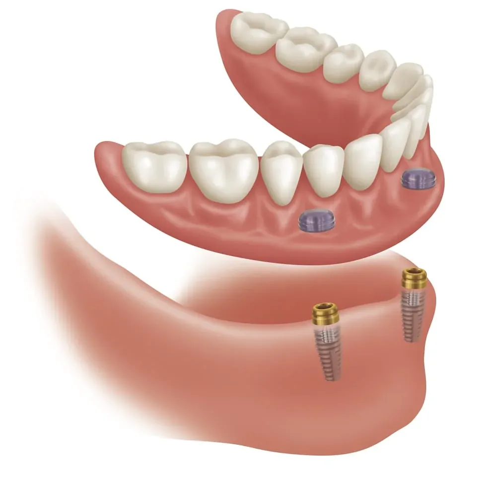 Illustration of a removable lower denture that clips onto two dental implants in the jaw